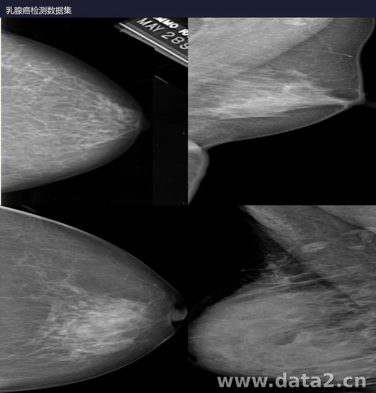 乳腺癌检测数据集 预览图