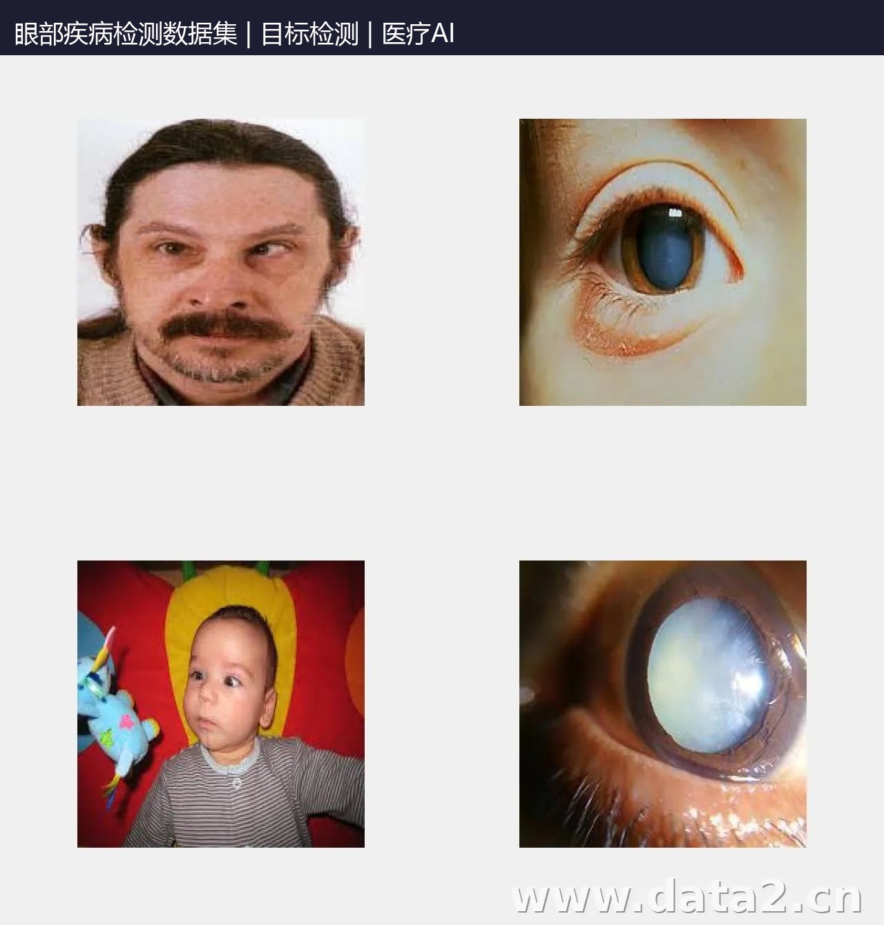 眼部疾病检测数据集 预览图