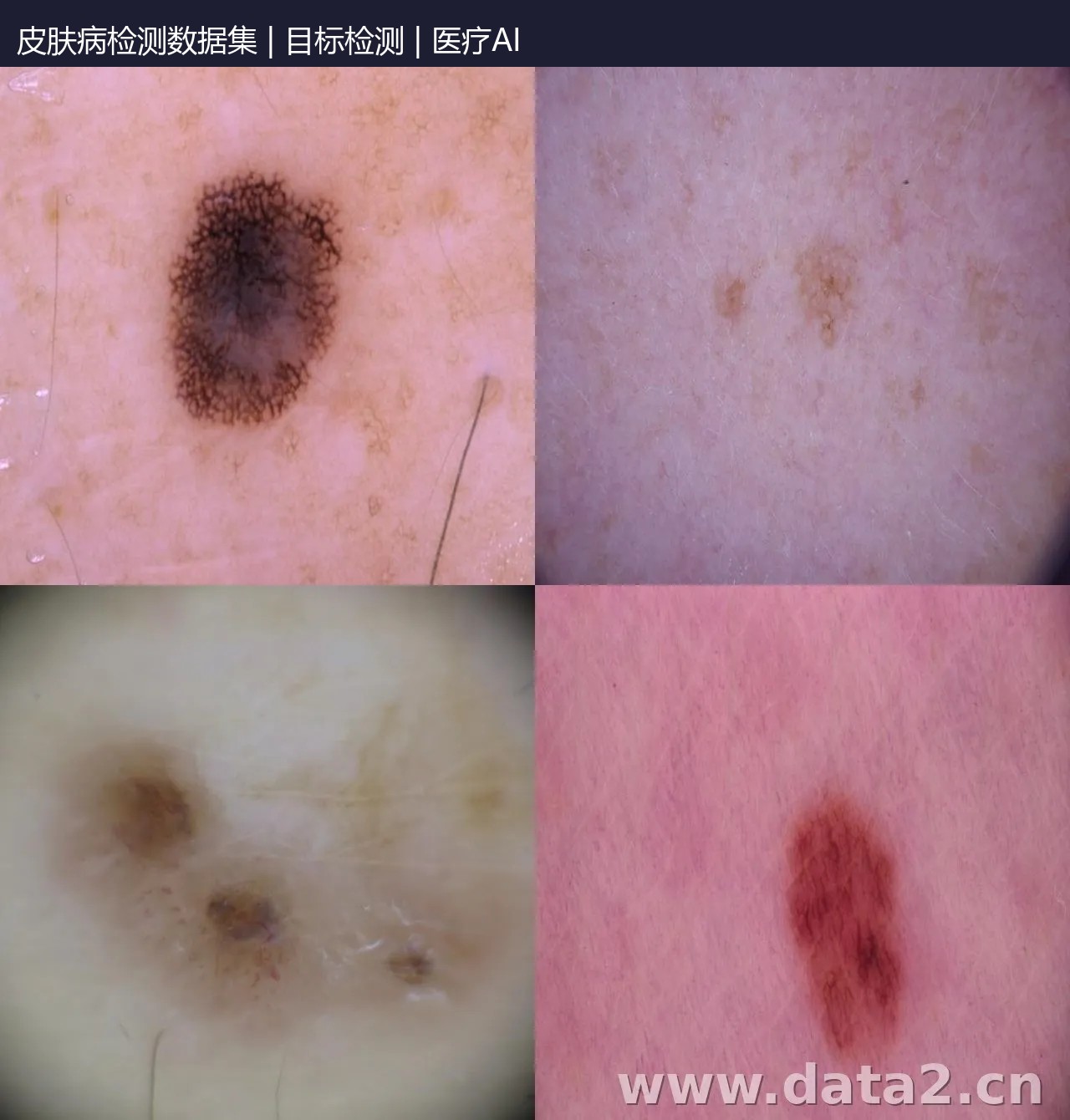 皮肤病检测数据集 预览图