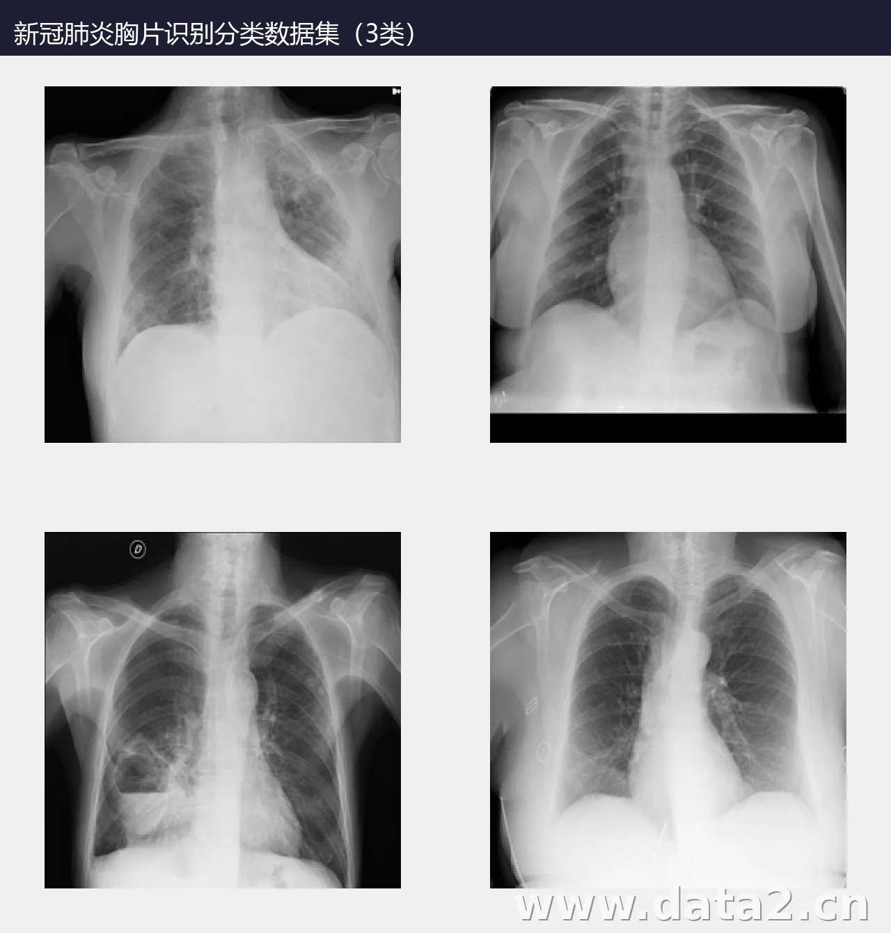 新冠肺炎胸片识别分类数据集(3类) 预览图