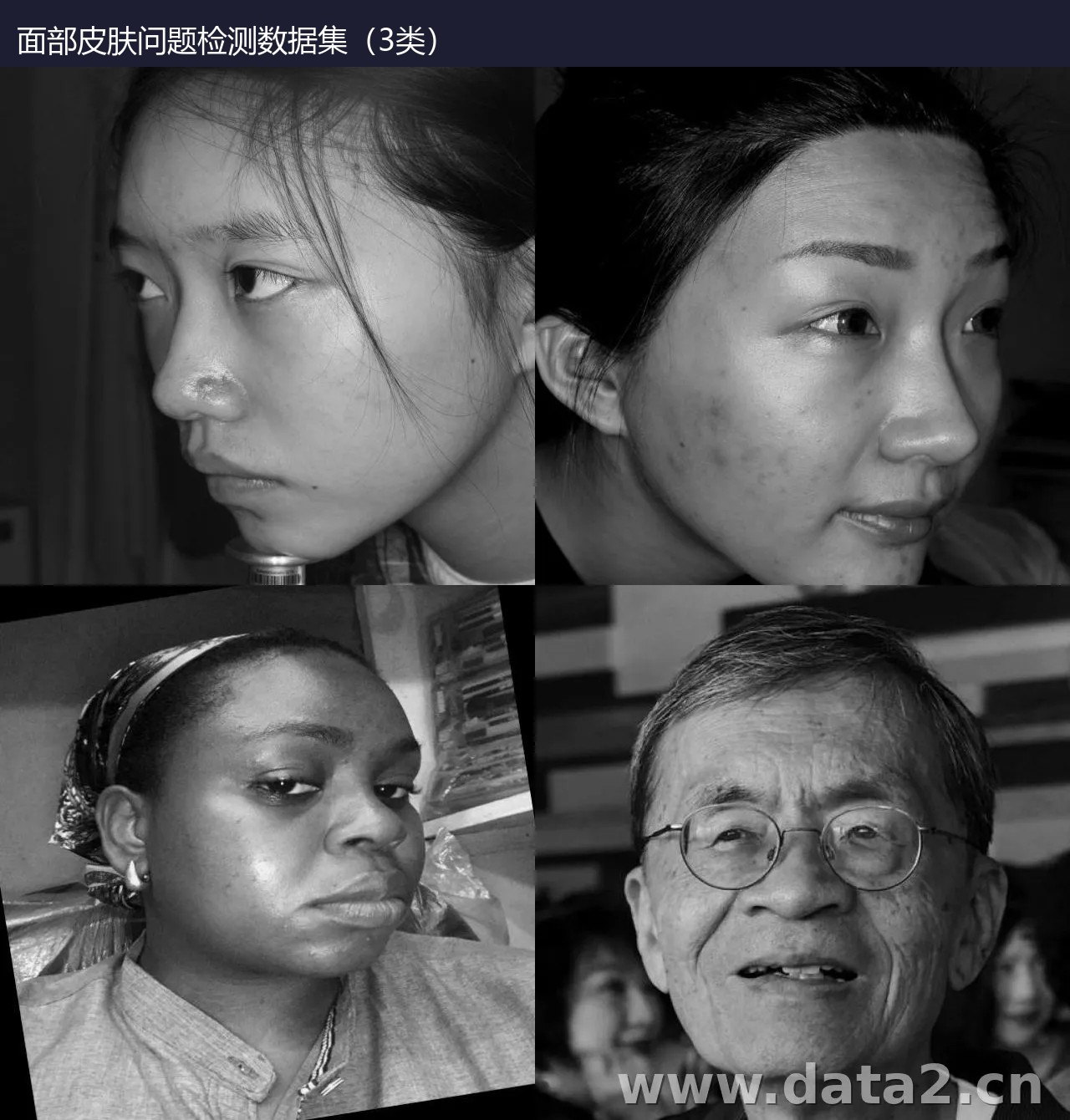 面部皮肤问题检测数据集(3类) 预览图