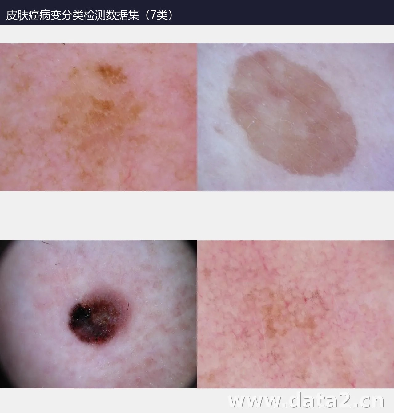 皮肤癌病变分类检测数据集(7类) 预览图